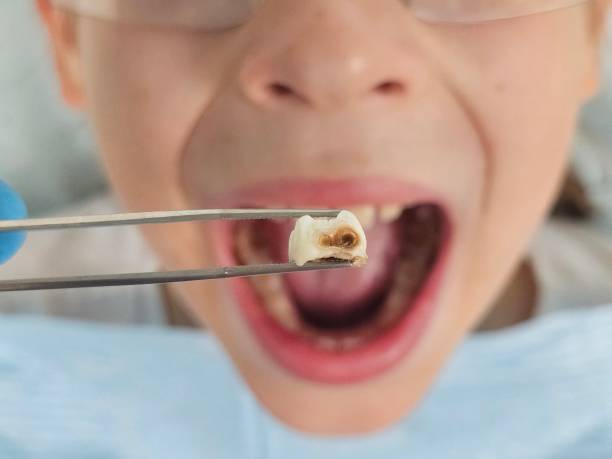 Best Emergency Root Canal Treatment in Kingsley, MI